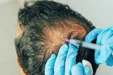 کاهش ریزش و افزایش ضخامت موها با استفاده از prp